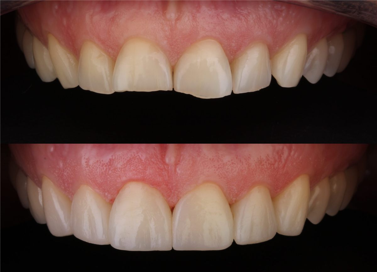 Veneers